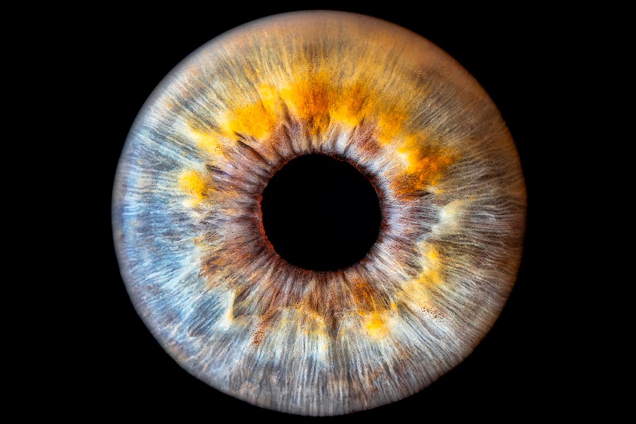 Forstørrelse af iris med lupbriller til øjenlæge